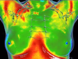 thermografisch borstonderzoek